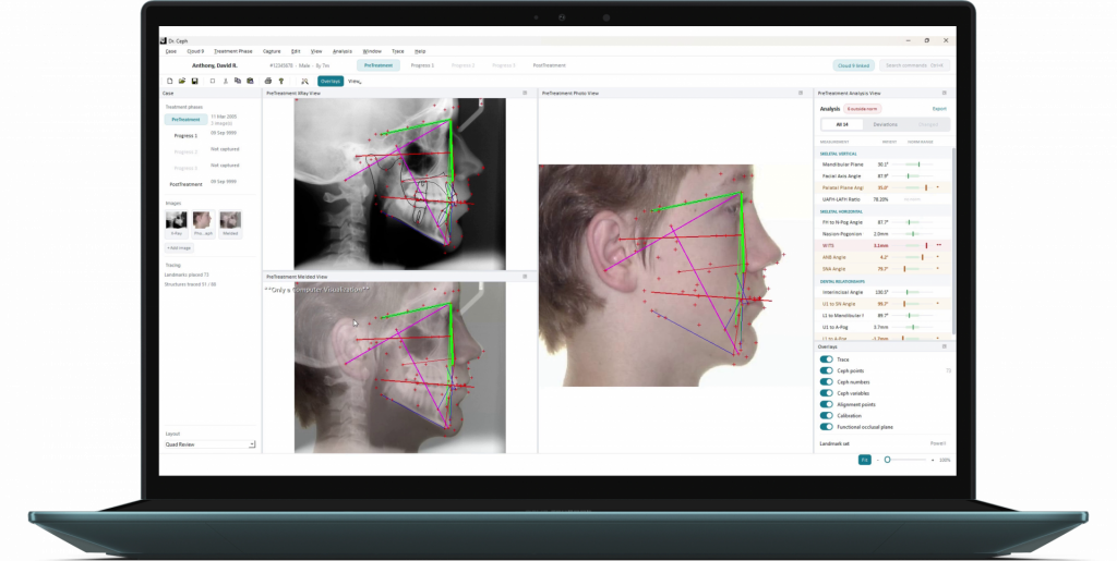 Modernized Dr. Ceph workspace with X-ray and facial tracing views, treatment phases, overlays, and analysis results.